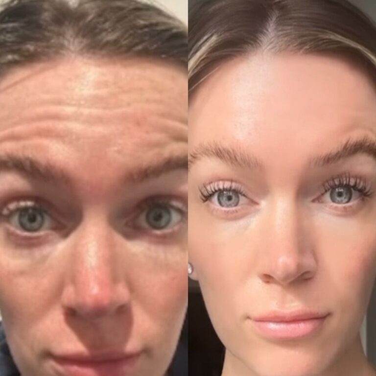 an alternative to botox