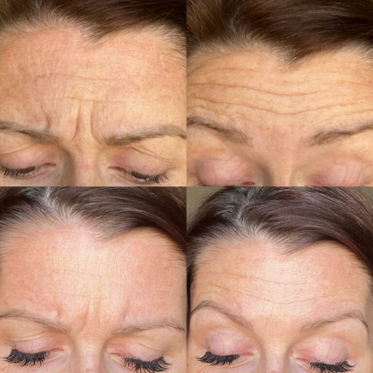 The Skincare Alternative to Botox Everyone's Talking About