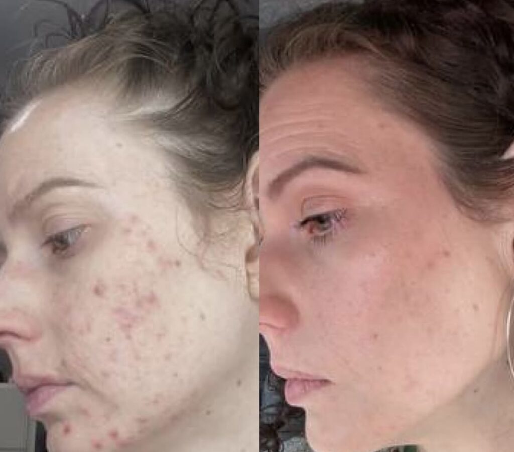 how my holistic skincare routine wiped out my acne and dry skin