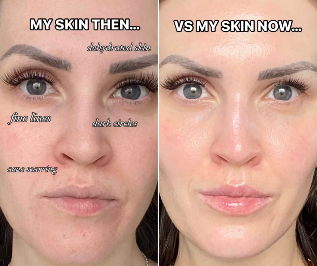 How I Cleared My Skin And Reduced Scarring